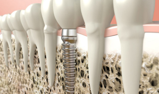 Mantenimiento de la higiene en pacientes con implantes