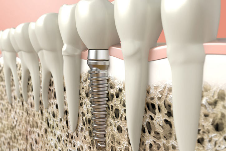 Mantenimiento de la higiene en pacientes con implantes