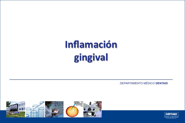 Inflamación gingival