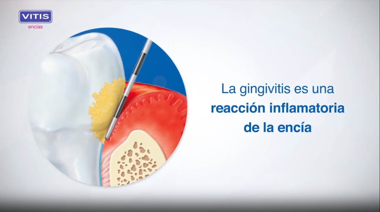 VITIS encías: gingivitis