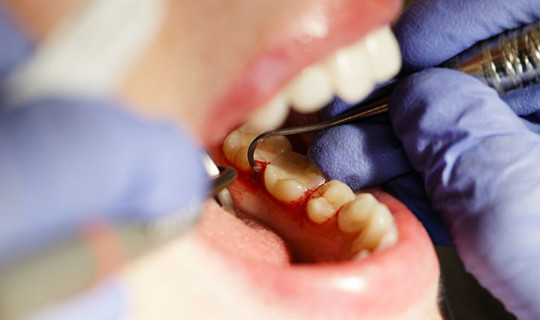 Causas del sangrado gingival