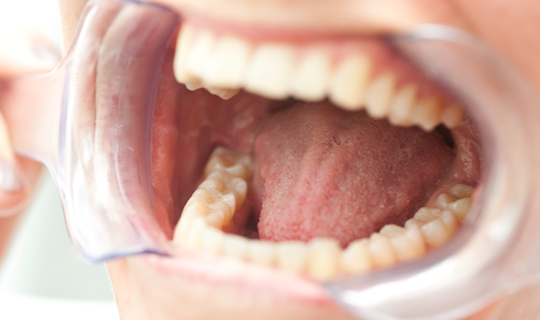 Por qué es importante limpiarse la lengua